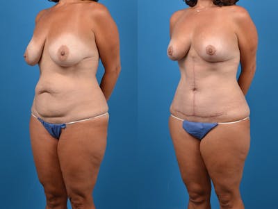 Post-Bariatric Surgery Before & After Gallery - Patient 14779180 - Image 2