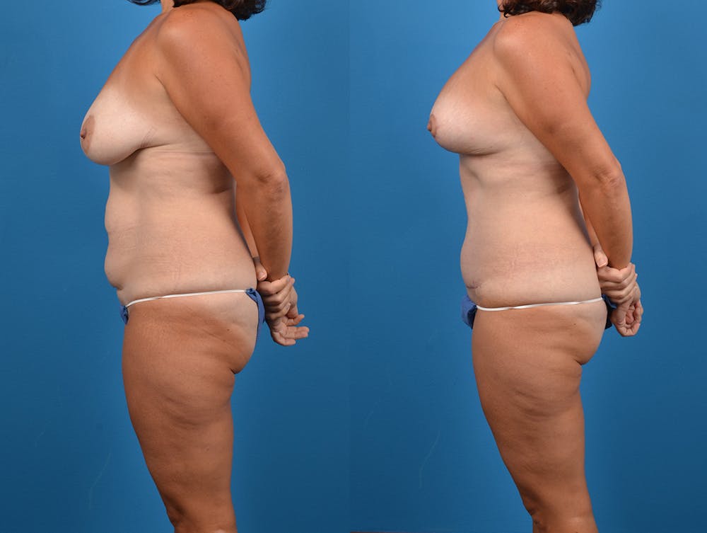 Post-Bariatric Surgery Before & After Gallery - Patient 14779180 - Image 3