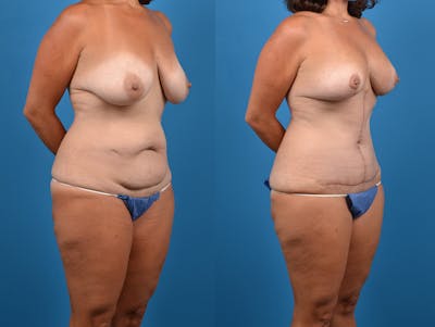 Abdominoplasty Before & After Gallery - Patient 14242433 - Image 4