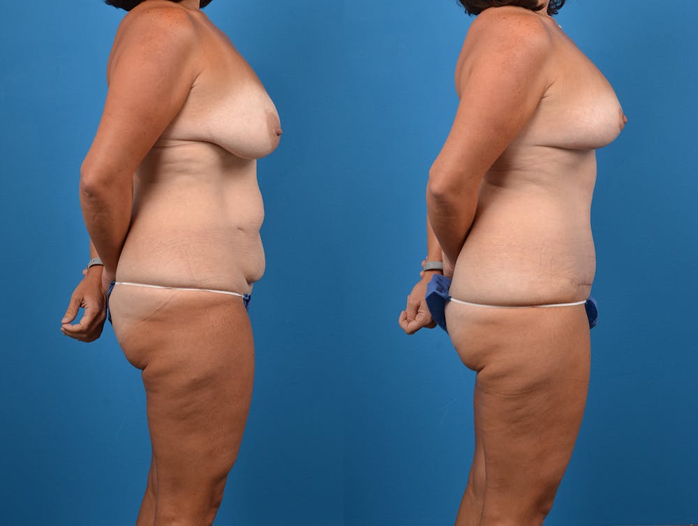 Post-Bariatric Surgery Before & After Gallery - Patient 14779180 - Image 5