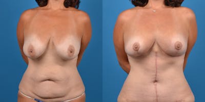 Mommy Makeover Before & After Gallery - Patient 14779178 - Image 6