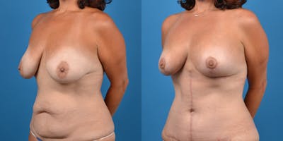 Breast Lift Before & After Gallery - Patient 14779179 - Image 2