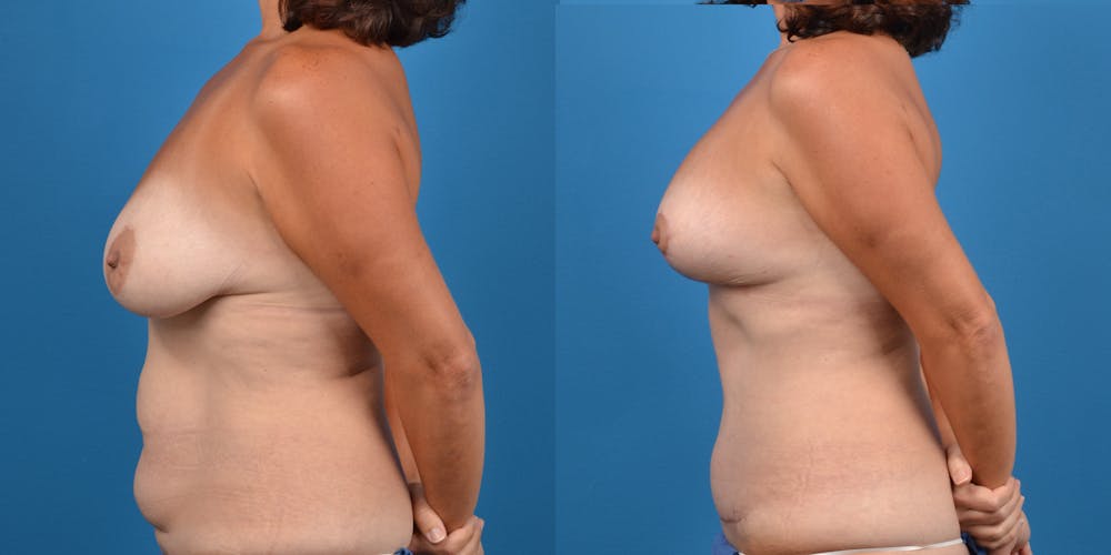 Breast Lift Before & After Gallery - Patient 14779179 - Image 3