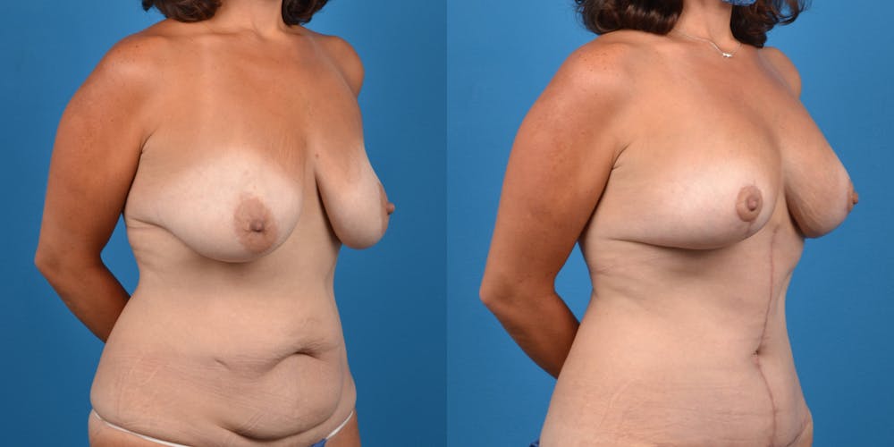 Breast Lift Before & After Gallery - Patient 14779179 - Image 4