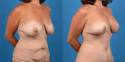 Breast Lift Before & After Gallery - Patient 14779179 - Image 4