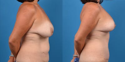 Mommy Makeover Before & After Gallery - Patient 14779178 - Image 10
