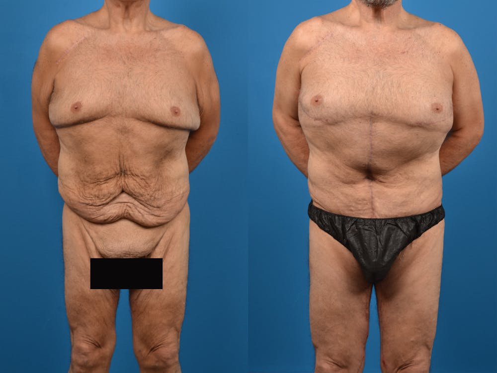 Thigh Lift Before & After Gallery - Patient 14779246 - Image 3