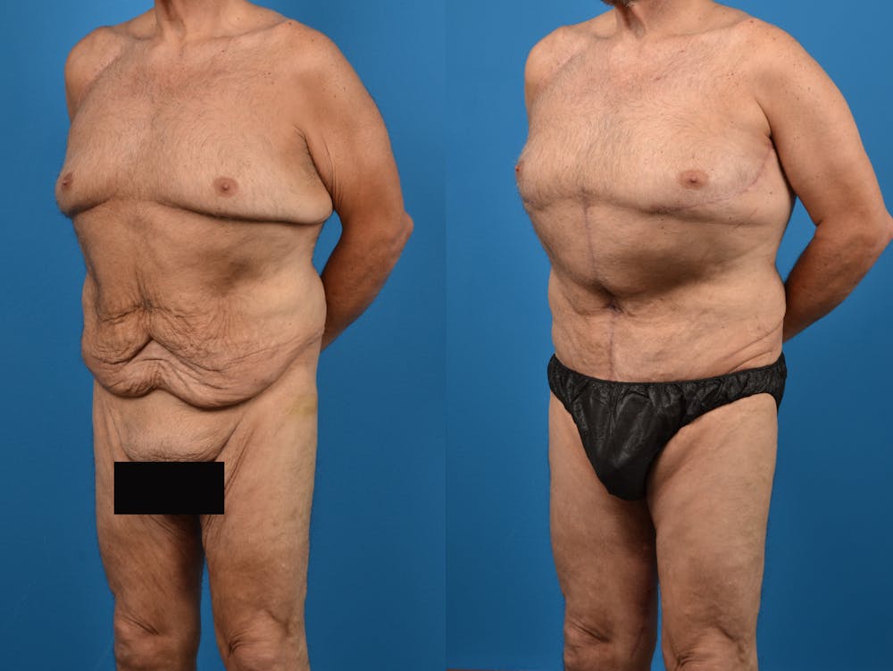 Post-Bariatric Surgery Before & After Gallery - Patient 14779217 - Image 2