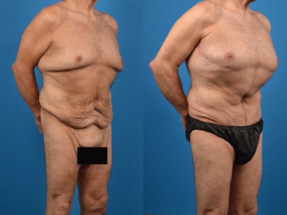 Abdominoplasty Before & After Gallery - Patient 14779210 - Image 3