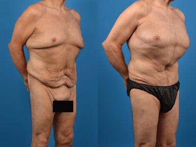 Thigh Lift Before & After Gallery - Patient 14779246 - Image 1