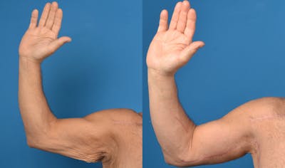 Brachioplasty Before & After Gallery - Patient 14779212 - Image 2