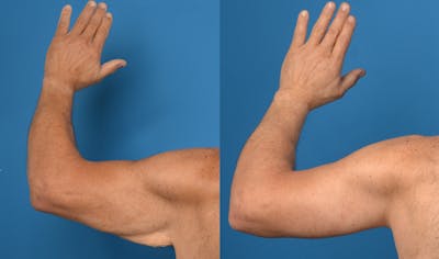 Brachioplasty Before & After Gallery - Patient 14779212 - Image 4