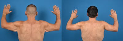 Brachioplasty Before & After Gallery - Patient 14779212 - Image 6