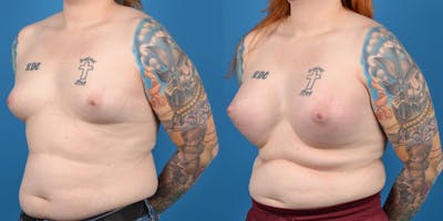 Transgender Surgery (MTF) Before & After Gallery - Patient 14779224 - Image 2
