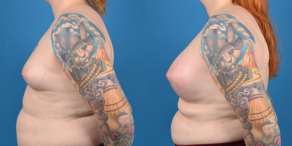 Transgender Surgery (MTF) Before & After Gallery - Patient 14779224 - Image 3