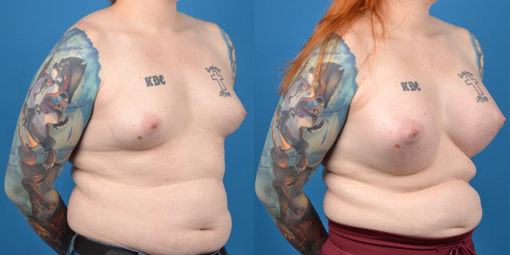 Transgender Surgery (MTF) Before & After Gallery - Patient 14779224 - Image 4