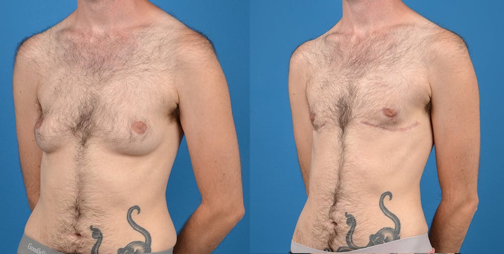Transgender Surgery (FTM) Before & After Gallery - Patient 14242527 - Image 2