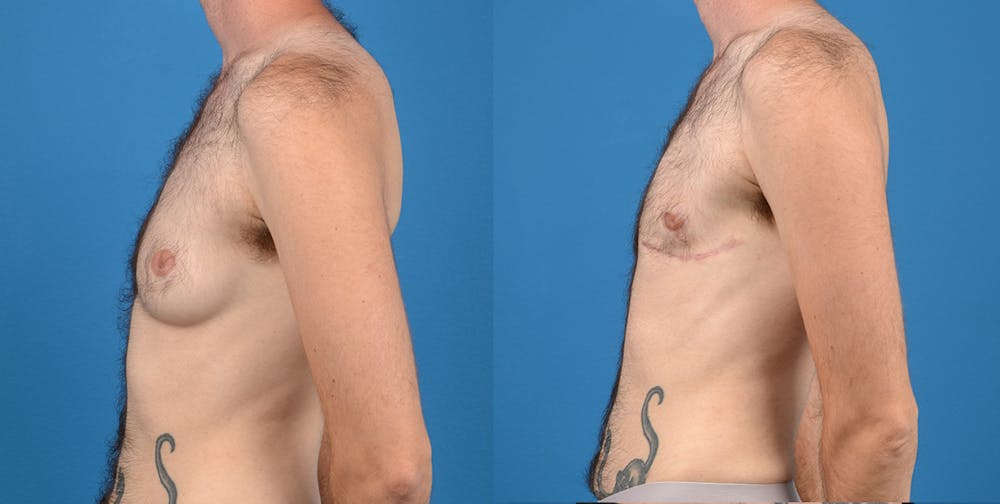 Transgender Surgery (FTM) Before & After Gallery - Patient 14242527 - Image 3