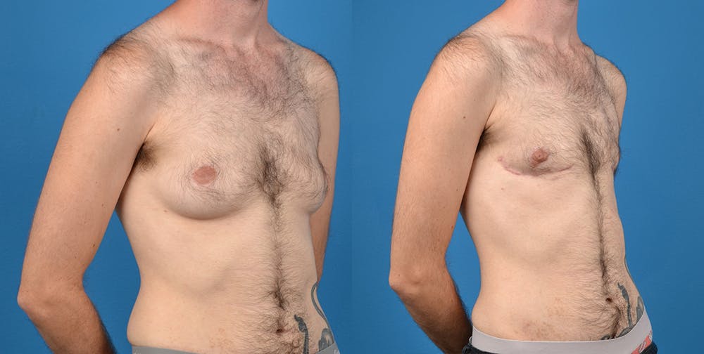 Transgender Surgery (FTM) Before & After Gallery - Patient 14242527 - Image 4