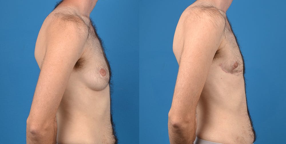 Transgender Surgery (FTM) Before & After Gallery - Patient 14242527 - Image 5