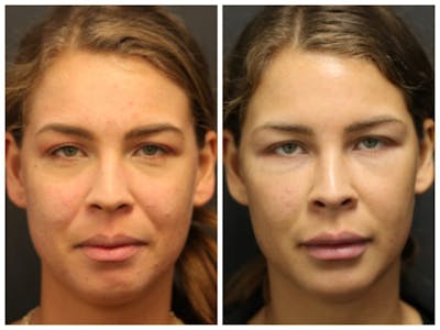 Acne Treatment Before & After Gallery - Patient 14779256 - Image 1