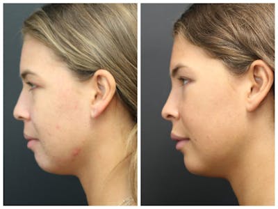 Acne Treatment Before & After Gallery - Patient 14779256 - Image 2