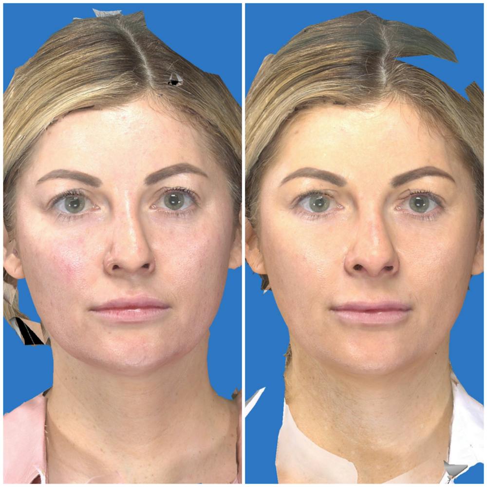 Patient 14779271 | Facelift Before & After Photos | The Maercks Institute Patient 14779271 | Facelift Before & After Photos | The Maercks Institute