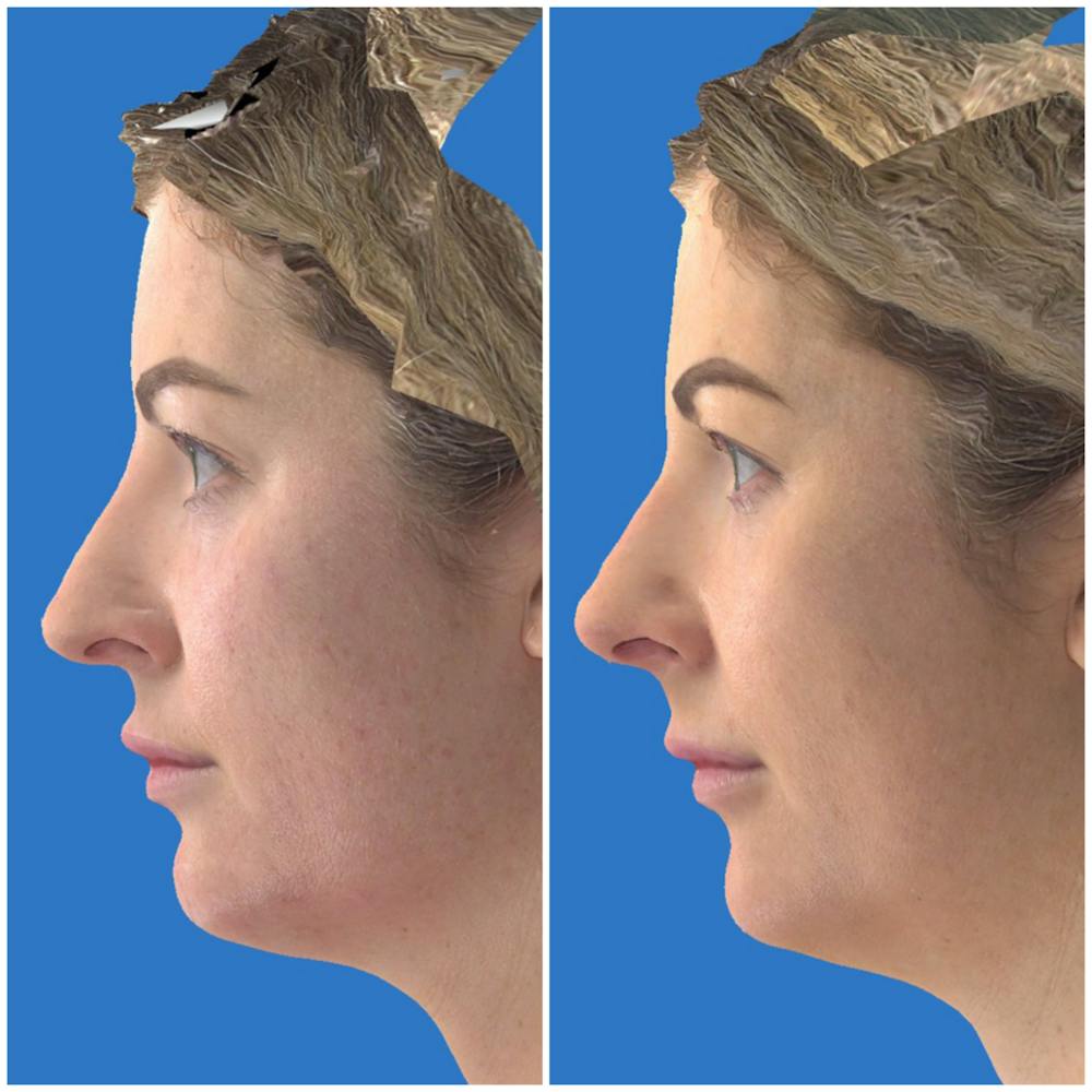 Aesthetic Facial Balancing Before & After Gallery - Patient 14779269 - Image 2