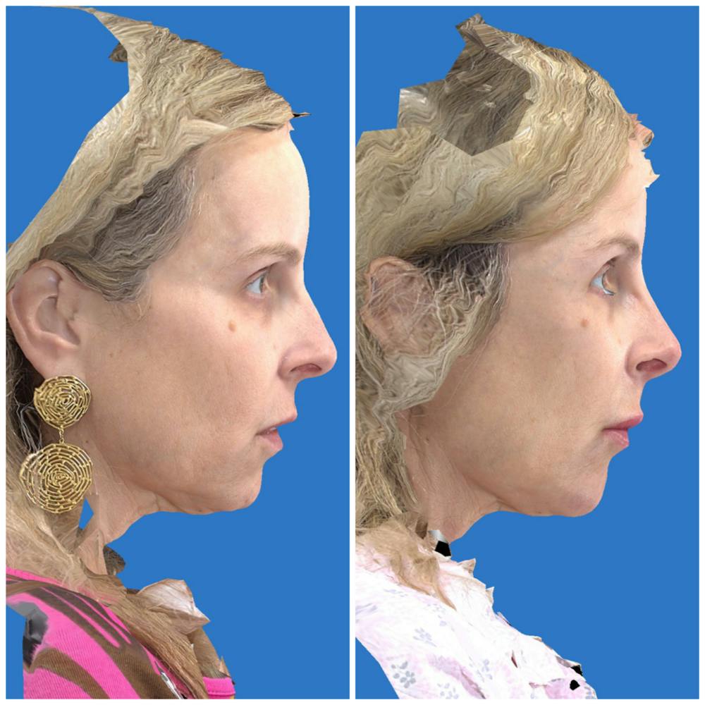 Aesthetic Facial Balancing Before & After Gallery - Patient 14779353 - Image 3