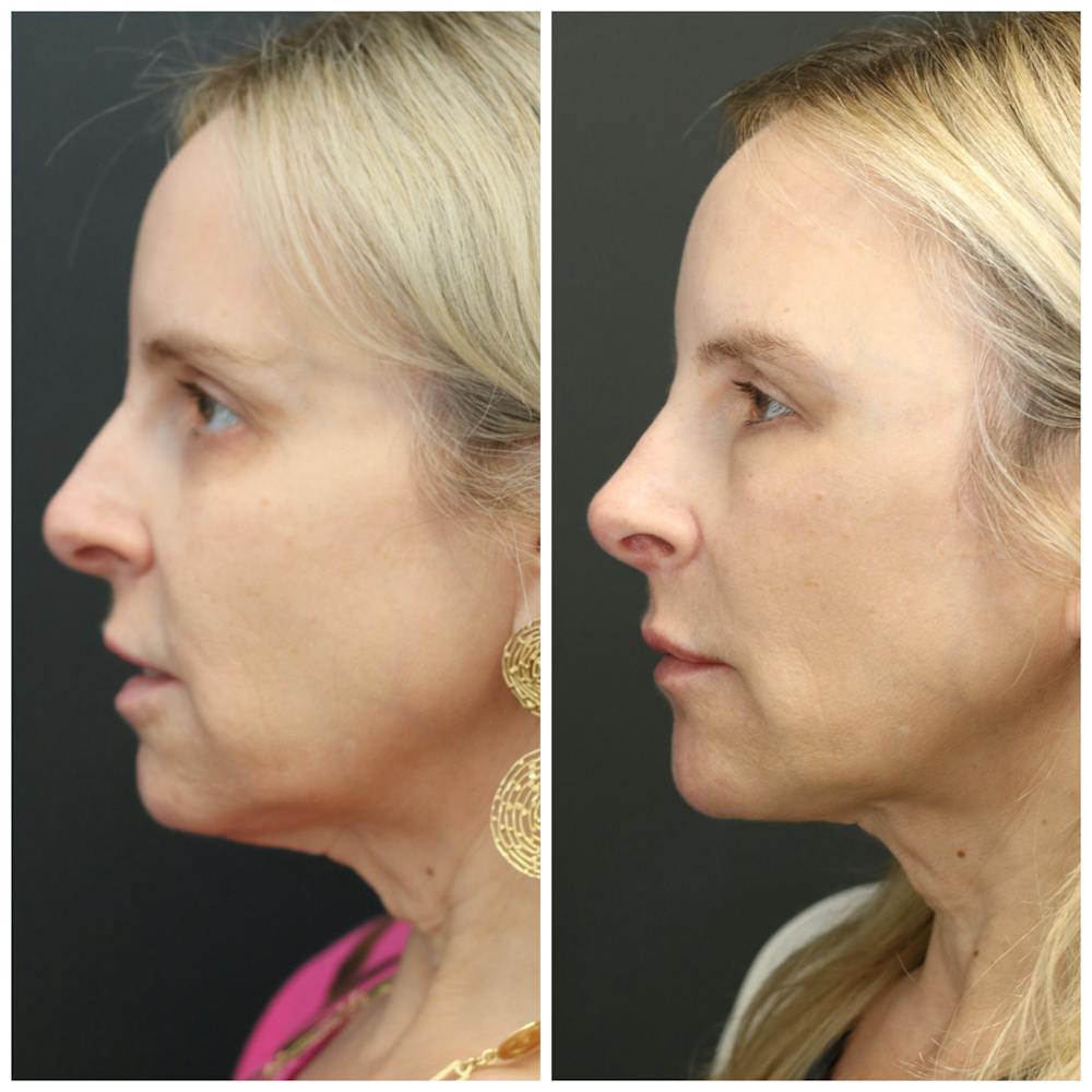 Liquid Facelift Before & After Gallery - Patient 14779277 - Image 2