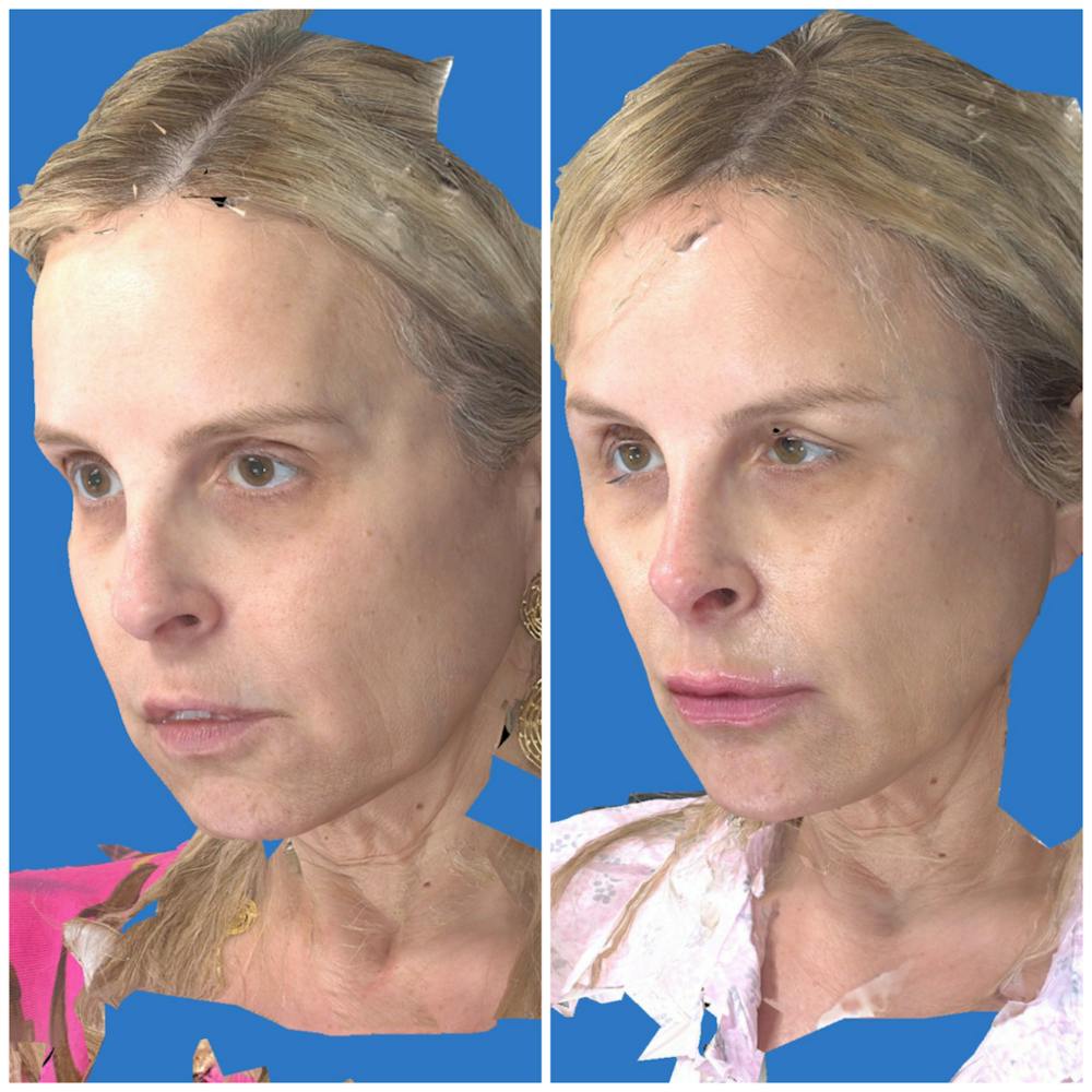 Liquid Facelift Before & After Gallery - Patient 14779277 - Image 3