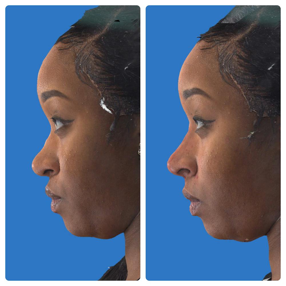 Aesthetic Facial Balancing Before & After Gallery - Patient 14779354 - Image 3