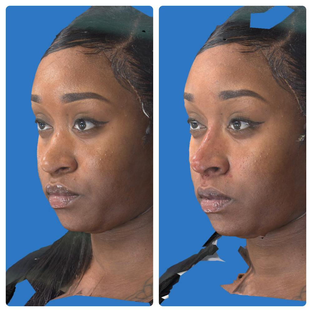 Aesthetic Facial Balancing Before & After Gallery - Patient 14779354 - Image 2