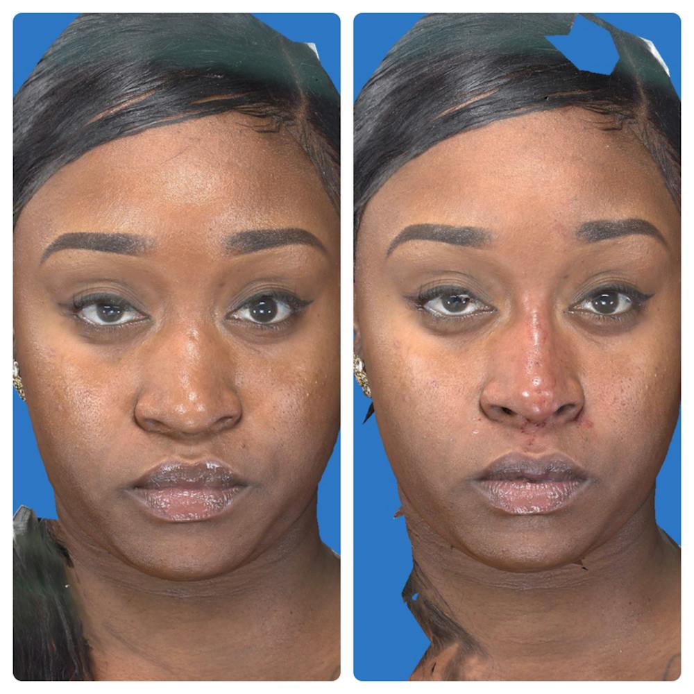 Liquid Rhinoplasty Before & After Gallery - Patient 14779300 - Image 2