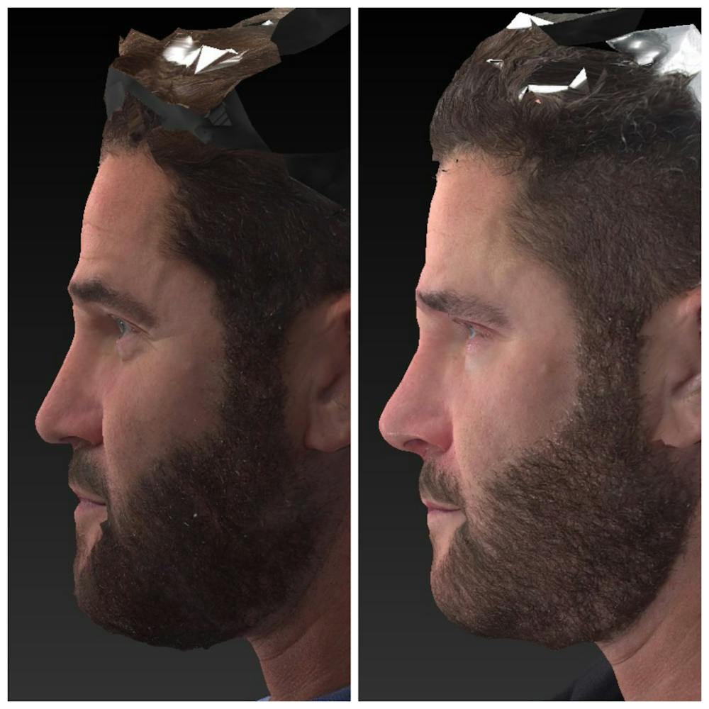Liquid Rhinoplasty Before & After Gallery - Patient 14779301 - Image 1