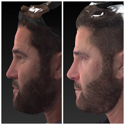 Liquid Rhinoplasty Before & After Gallery - Patient 14779301 - Image 1