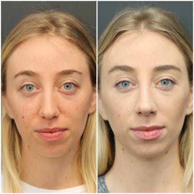Under Eye Filler Before & After Gallery - Patient 14779347 - Image 1