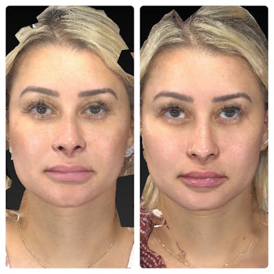 Aesthetic Facial Balancing Before & After Gallery - Patient 14779376 - Image 1