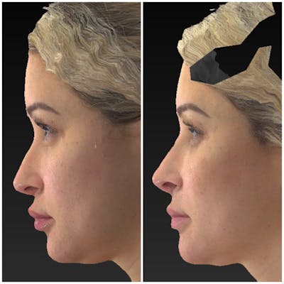 Aesthetic Facial Balancing Before & After Gallery - Patient 14779376 - Image 2