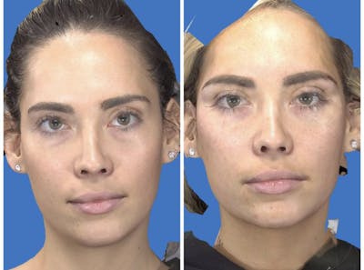 Aesthetic Facial Balancing Before & After Gallery - Patient 14779379 - Image 1