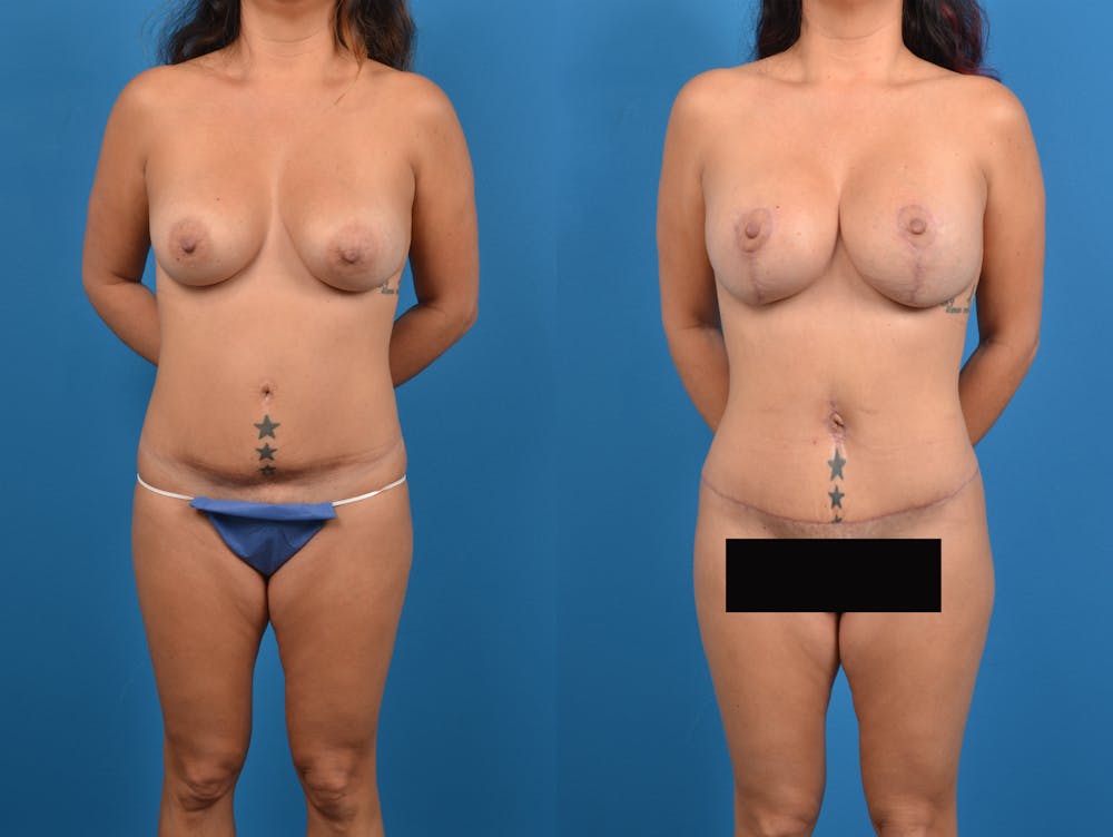 Abdominoplasty Before & After Gallery - Patient 15615549 - Image 1