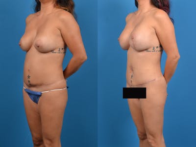 Abdominoplasty Before & After Gallery - Patient 15615549 - Image 2