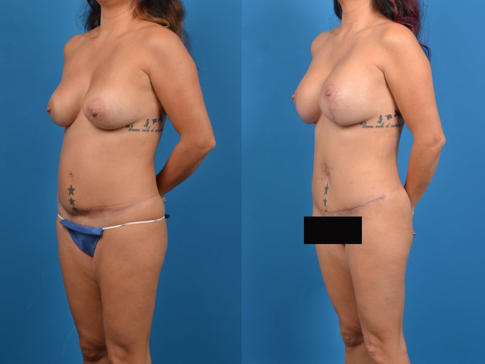 Abdominoplasty Before & After Gallery - Patient 15615549 - Image 2
