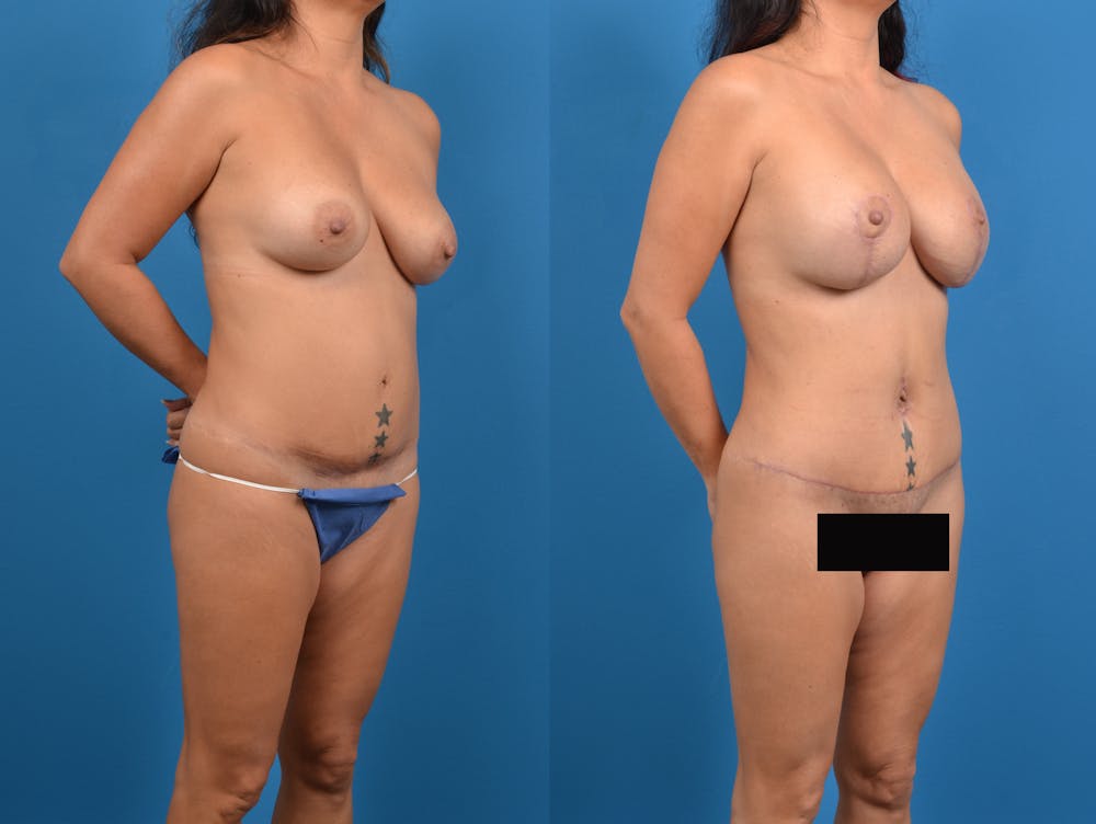 Abdominoplasty Before & After Gallery - Patient 15615549 - Image 3