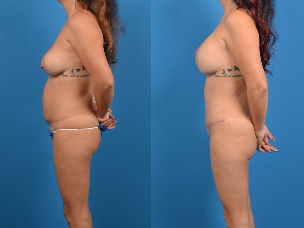 Abdominoplasty Before & After Gallery - Patient 15615549 - Image 4