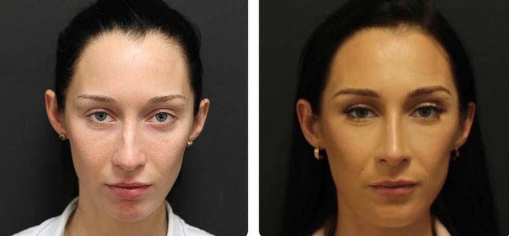 Rhinoplasty Before & After Gallery - Patient 11681676 - Image 4