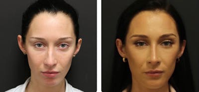 Aesthetic Facial Balancing Before & After Gallery - Patient 11681593 - Image 1