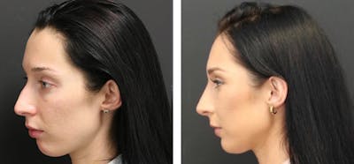 Rhinoplasty Before & After Gallery - Patient 11681676 - Image 2