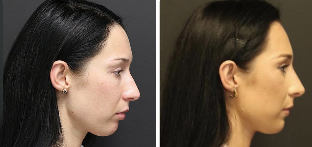 Aesthetic Facial Balancing Before & After Gallery - Patient 11681593 - Image 4