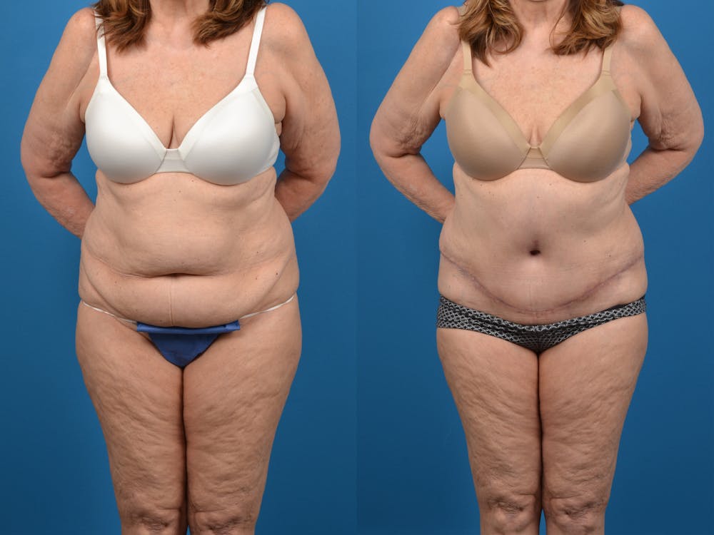 Tummy Tuck